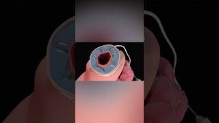 Gastric Band Adjustment medicalanimation health [upl. by Etnuahs]