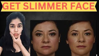 Get slimmer face with Botox  Dr Anvika 8287001211 [upl. by Decrem]