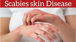 Scabies Signs Symptoms Causes and Treatment [upl. by Hadrian]