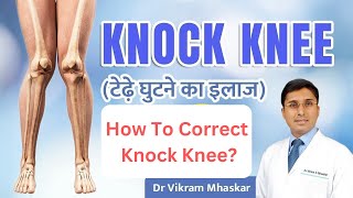 👉 Knock Knees Kaise Thik Kare Causes  Knock Knee Problem Solution टेढ़े घुटने का इलाज In Hindi [upl. by Stafford]