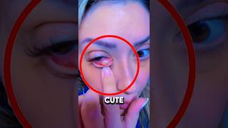 Pimple On Eye 👀 pimplepopping pimplepopper pimpleremoval pimplepop [upl. by Caryn]