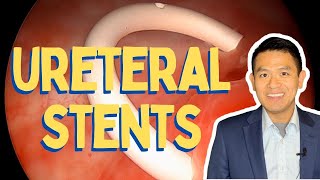 Ureteral Stent Insertion and Removal  Procedure in Detail [upl. by Analeh222]