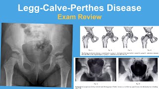 LeggCalvePerthes Disease Coxa Plana Exam Review  Rachel Goldstein MD [upl. by Nnaeed]