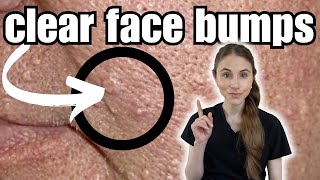 How To Clear And Prevent Face Bumps  Sebaceous Hyperplasia [upl. by Ahcurb104]