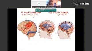 Hypertension Intracrânienne  Professeur ABDENNEBI [upl. by Eimme]