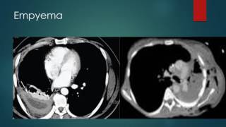 Empyema Complicated parapneumonic effusion  Chest InfectionsDR WARUNA KARUNARATNE [upl. by Ailerua472]