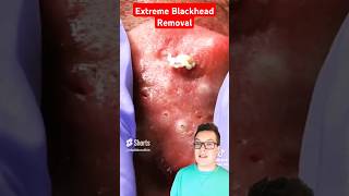 Worlds Most Extreme BLACKHEAD REMOVAL  Its A Fail shorts [upl. by Silverts]