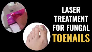 Laser Treatment For Fungal Toenails [upl. by Einafpets]