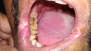 Leukoplakia signs and symptoms [upl. by Athallia857]