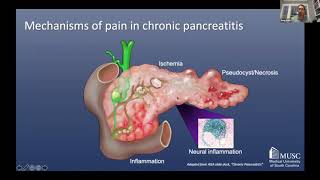 Endotherapy in Pancreatic Disorders by Greg Cote MD MUSC  Pancreas Academy 2020 [upl. by Iormina]