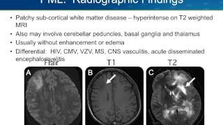 Progressive Multifocal Leukoencephalopathy PML [upl. by Ardle]