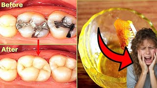 दांतों की सड़न और दर्द को दूर करने का सरल उपाय – How to Get Rid of Tooth Cavities and Pain Naturally [upl. by Walls]