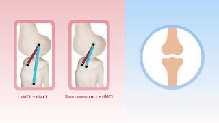 Alternative Medial Collateral Ligament Reconstruction Techniques [upl. by Atirehgram]