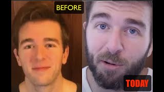 He Used 7000 MG Of Steroids PER WEEK And This Is What Happened To Him [upl. by Ainesell131]