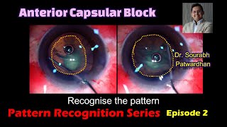 257 Anterior capsular block pattern recognition to avoid hydro rupture of PC Dr Sourabh Patwardhan [upl. by Sisenej]