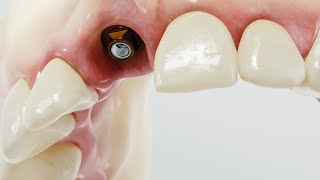 Precision Dentistry with DeSR Abutment [upl. by Kazmirci]