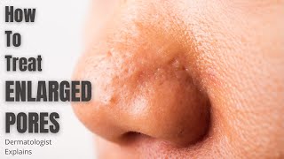 Enlarged Pores  How to effectively treat [upl. by Zawde]