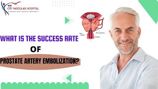 Prostate Artery Embolization Success vs common TURP prostate surgery [upl. by Cartwell625]