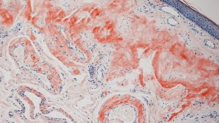 What is Amyloid  Pathology mini tutorial [upl. by Schoenfelder976]