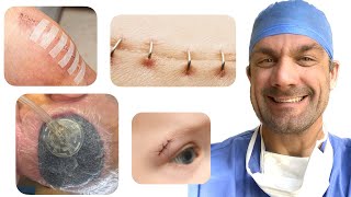 How do I close surgical wounds What are my options [upl. by Huggins]