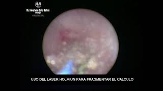 LITOTRICIA LASER EN CALCULO URETERAL DERECHO 2 [upl. by Sirtimid]