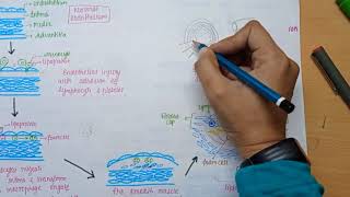 Atherosclerosis  Cause  pathology  Coronary Artery Disease in Hindi [upl. by Ynahpit]