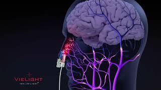 Vielight 633655nm Systemic Intranasalonly Visualization [upl. by Nnylyaj]