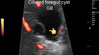 Ciliated foregut cyst of gallbladder very rare case ultrasound amp color Doppler overview [upl. by Akiwak]