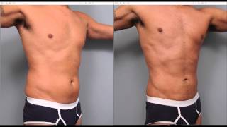 The Benefits of Liposuction for Men  Dr Sterry Explains [upl. by Ytram]