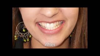 Invisalign for Adults A Better Way to a Straighter Smile [upl. by Bbor]