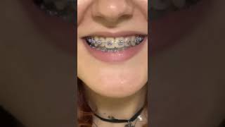 Orthodontics process short [upl. by Olivia]