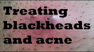 Understanding Blackheads and Acne Treatment [upl. by Alliber]