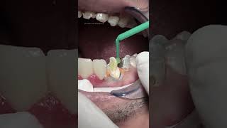 Composite with fiber post dentist [upl. by Buchalter836]