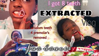 I GOT 8 TEETH REMOVED AT ONCE  vlog [upl. by Abisia]