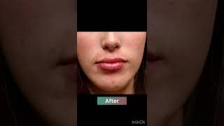 Lip filler session beforeandafter lips filler lipfiller [upl. by Annaynek]