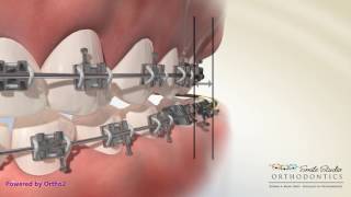 Elastics  Crossbite  Orthodontic Treatment [upl. by Luhar]