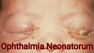 Ophthalmia Neonatorum Neonatal Conjunctivitis causes Treatment [upl. by Eta228]