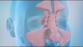 Sinusitis and Sinus Surgery Explained Balloon Sinuplasty and Endoscopic Sinus Surgery [upl. by Ocram]