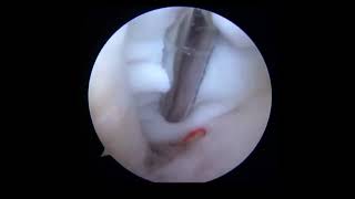 Arthroscopic Excision of a Deep Infrapatellar Cyst [upl. by Ennywg]