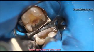 Onlay preparation on tooth 36 with distal margin coronal relocation [upl. by Tila593]