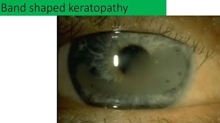 Band shaped keratopathy explained [upl. by Herminia998]