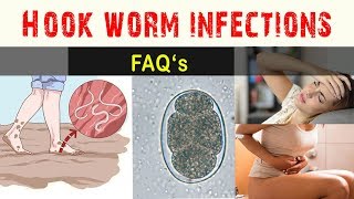 Hook worm Infections  FAQ and Answers [upl. by Caniff707]