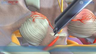 Animation MultiZYTE RT – Facet Denervation [upl. by Eladnek]