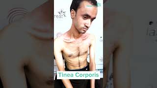 Tinea Corporis  Testimonial  Dhaka Dermatology Institute [upl. by Oguh489]