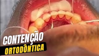 Contenção ortodôntica Muito importante para o sucesso do seu tratamento [upl. by Nyliuqcaj]