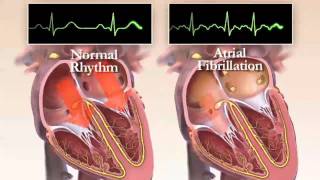 What is Atrial Fibrillation Chapter 1 HRS Patient Video [upl. by Vladimar]