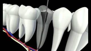 Root Canal Procedure 3D Animation  Endodontics Los Angeles [upl. by Miyasawa]