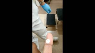 How to treat Warts Cryotherapy [upl. by Htenaj198]