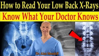 How to Read Your Low Back Xrays Know What Your Doctor Knows  Dr Alan Mandell DC [upl. by Bowles]