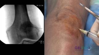 Inferior Lateral Extended Knee GELSYN3 [upl. by Sherye]